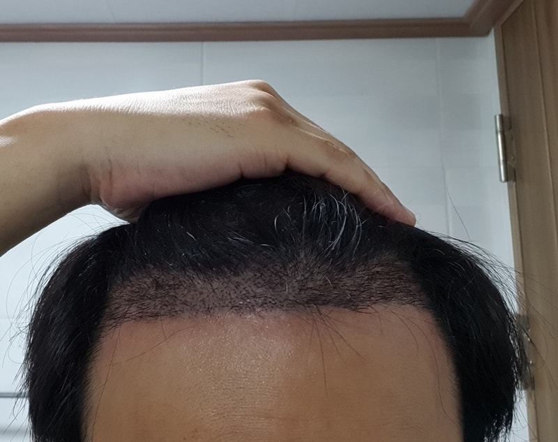 수술 후 2주 병원 방문 후.jpg