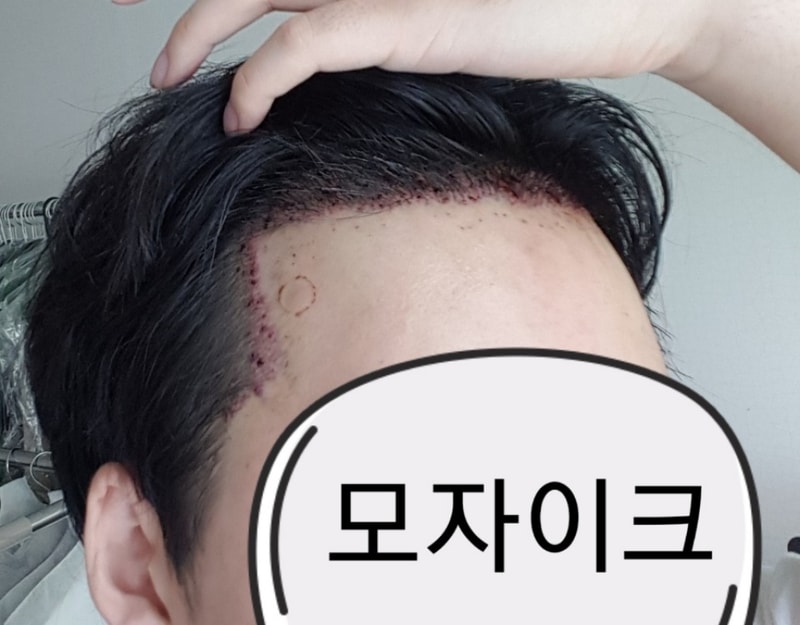 수술 다음날 샴푸후 오른쪽.jpg