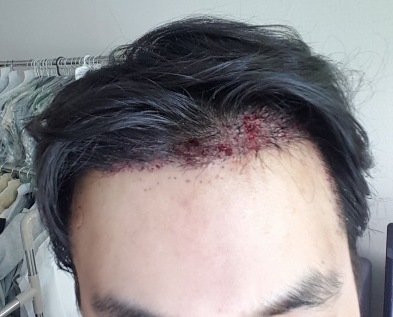 수술 다음날 샴푸후 정면2.jpg