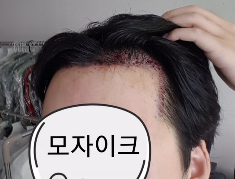 수술 다음날 샴푸후 왼쪽.jpg
