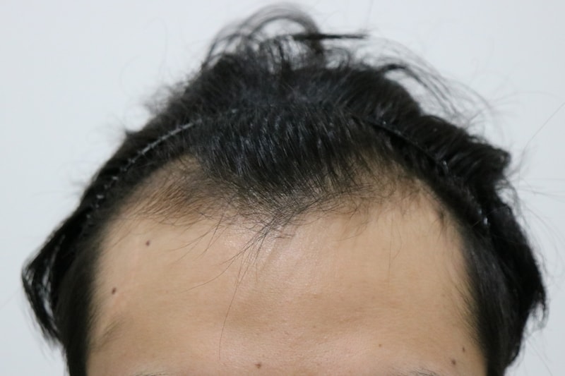 수술전정면.jpg
