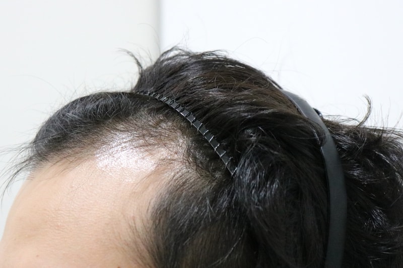 수술전좌측.jpg