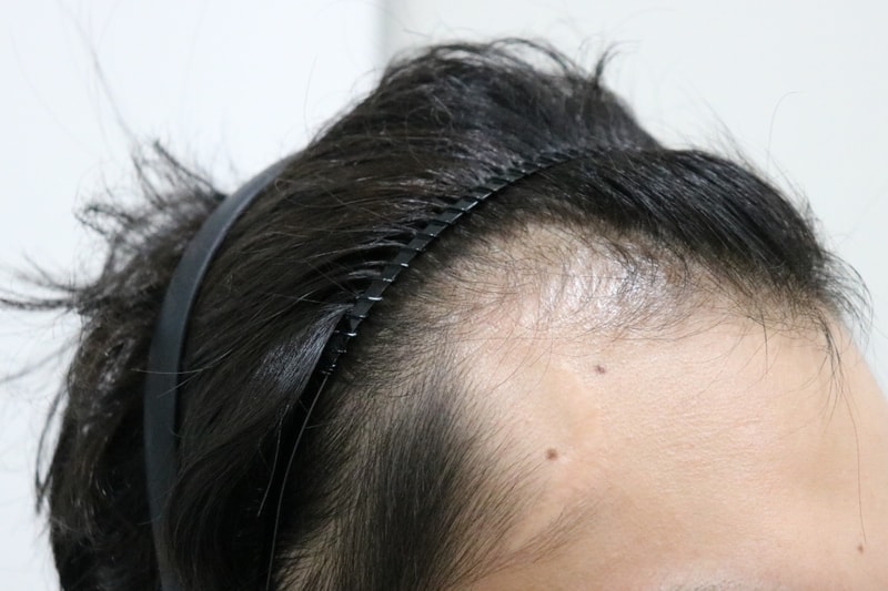 수술전우측.jpg