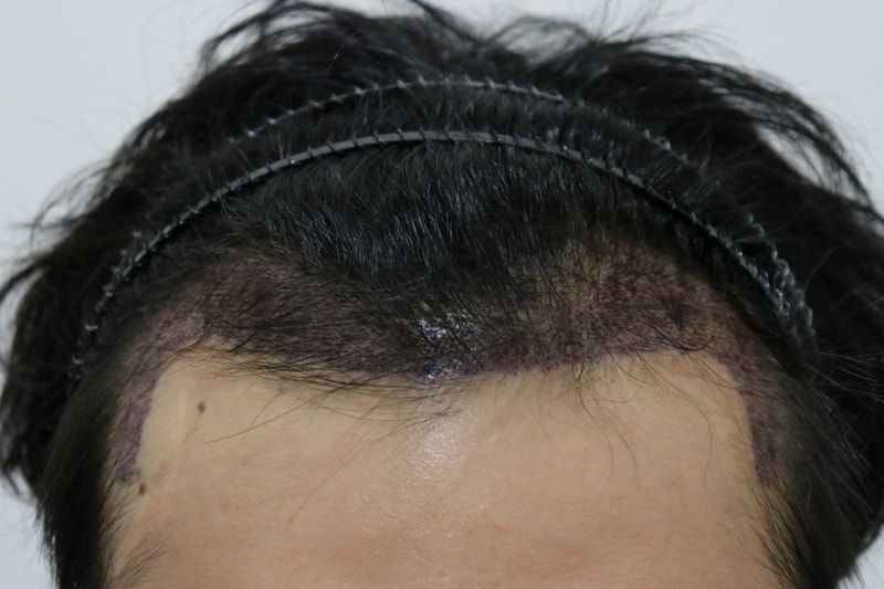 수술후정면.jpg
