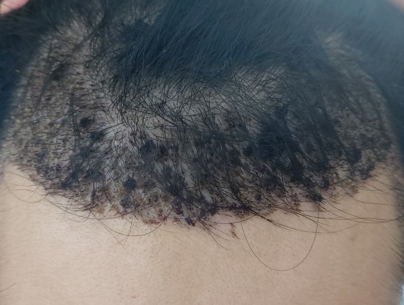 It's the 16th day of Daegu branch's non-cut 1800 hair follicles