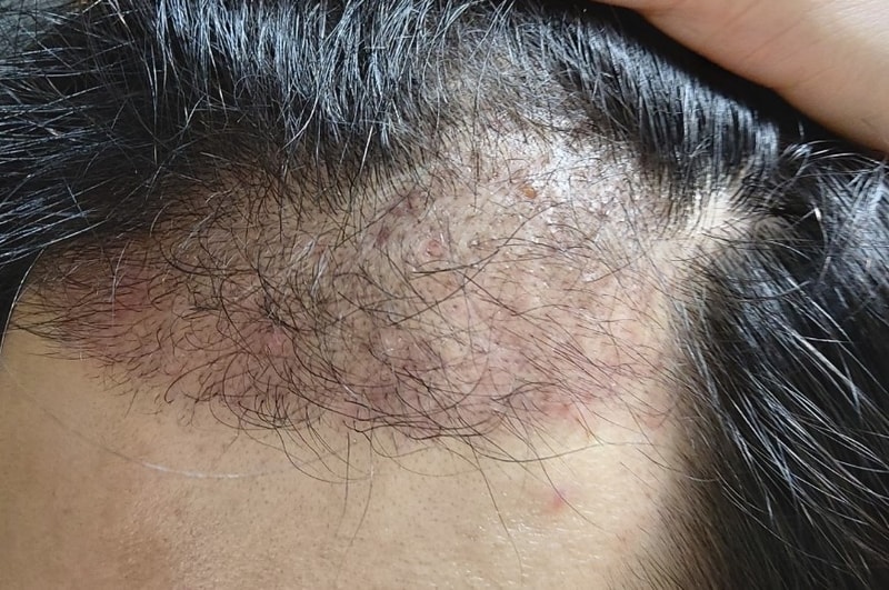 This is the review of the 98th day of 1800 hair follicles.