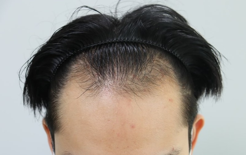 Non-cut 1800 hair follicle hair transplant 9 months later