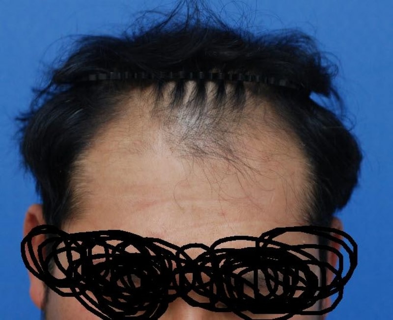 수술전 앞.jpg