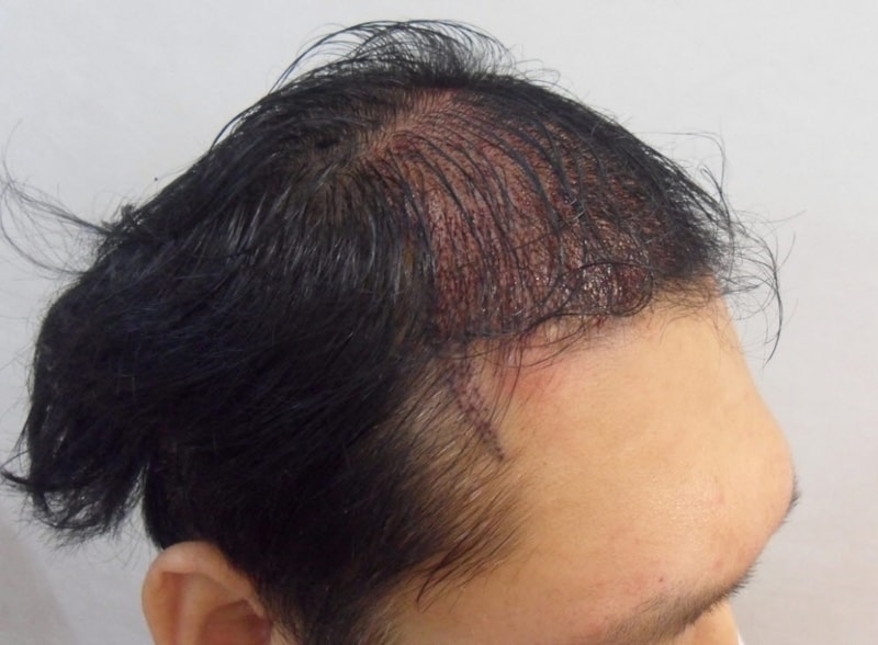 수술후 옆.jpg