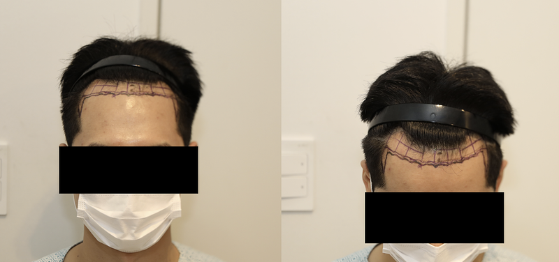 뉴헤어모발성형외과 비절개모발이식 9개월차 수술후기 (1500모낭,3000모)