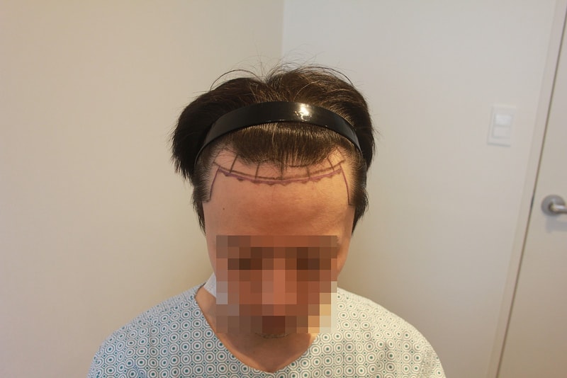 뉴헤어 서울점 모발이식 헤어라인교정 1200모낭(2400모) 10개월차 후기