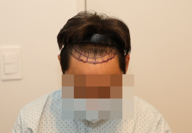 1600모낭 절개모발이식 후기