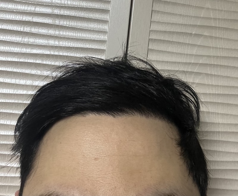 뉴헤어 모발이식 절개 4300모 9개월차 후기