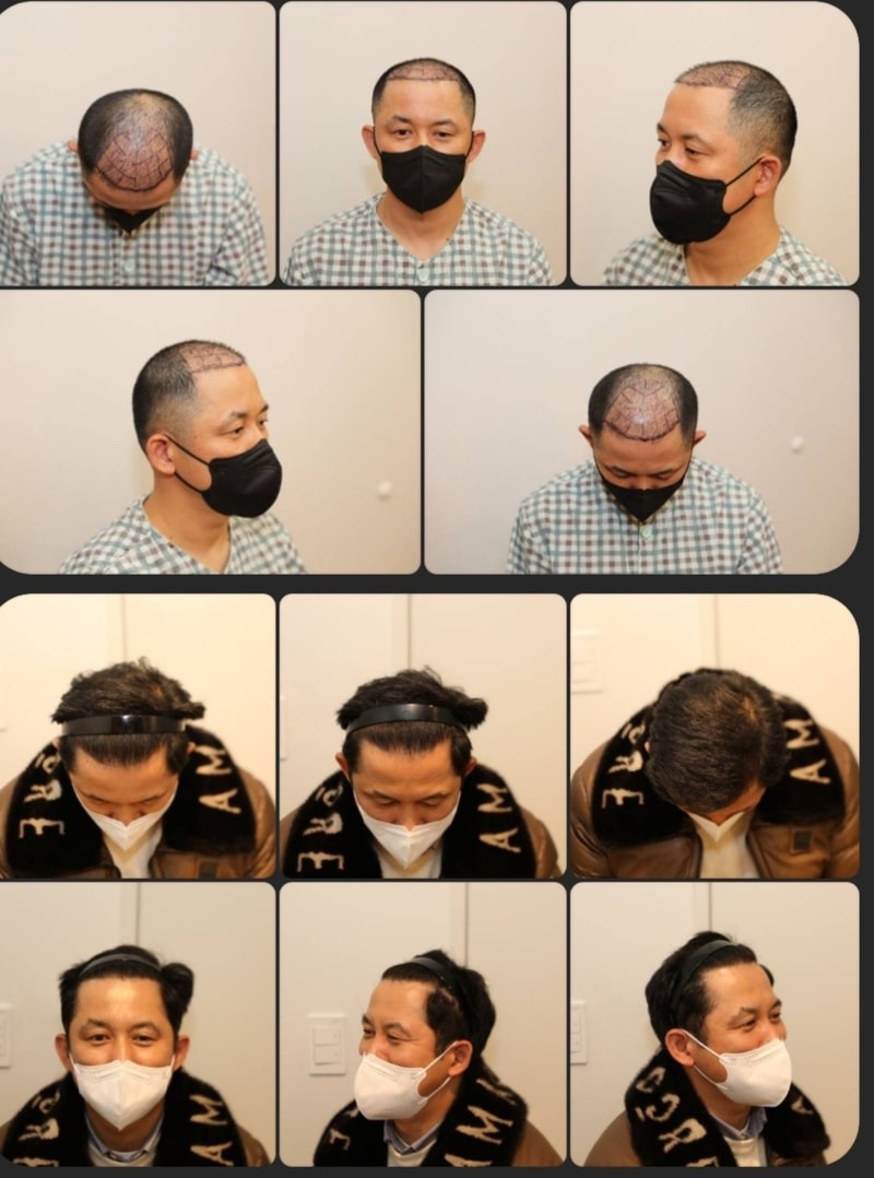 뉴헤어 모발이식 1년차 후기