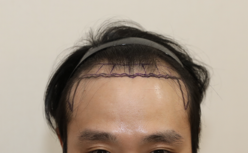 절개 모발이식 1년 3개월차 후기ㅣ뉴헤어