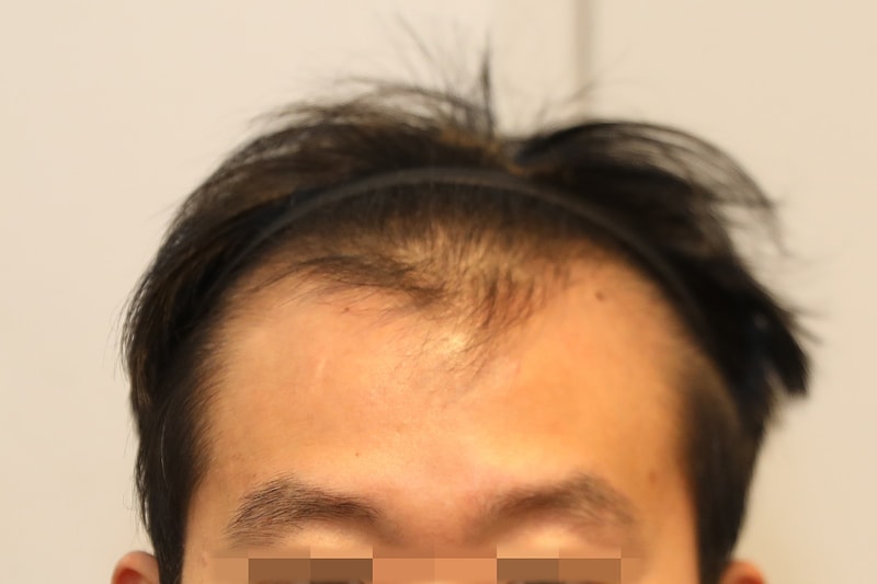 뉴헤어 절개 모발이식 5일차 후기 (2123모낭)