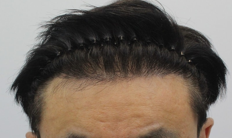 수술 후 3.jpg