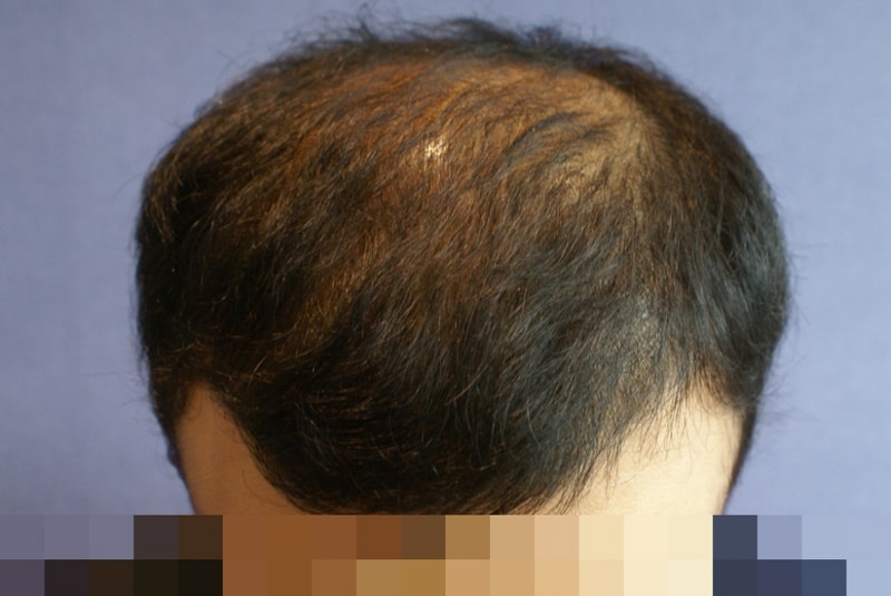 모션 헤어라인+정수리 3000모낭 이식 사진
