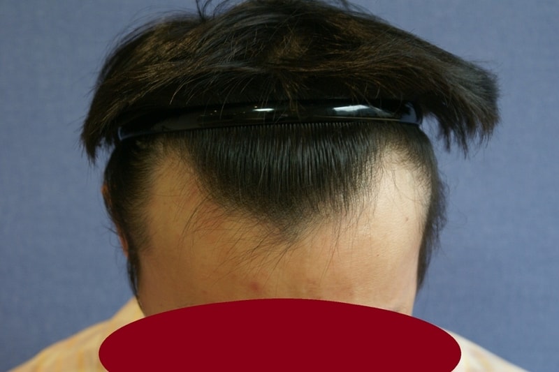 모션모발이식센터 비절개 무삭발 1000모낭 이식