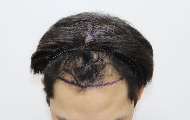 2.수술전 디자인.JPG