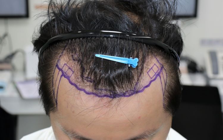 Forehead Seoul Branch Hair Transplantation in 7 Months