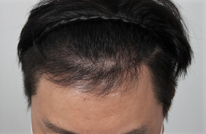 3.이식 4달후.JPG