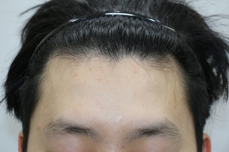 비절개 900모낭 4개월 후기