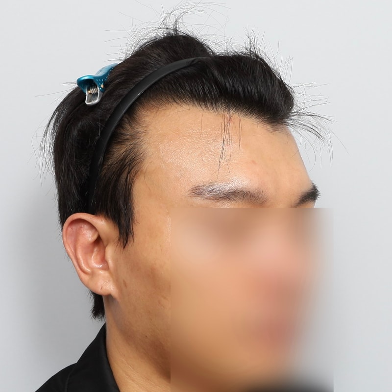 부분삭발 비절개 1322모낭 10일차 경과 기록!!