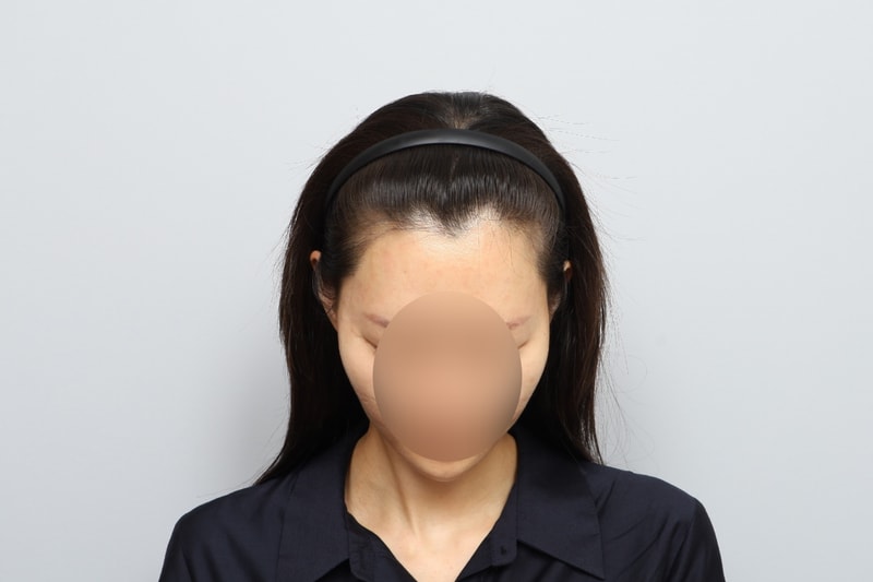 모원성형외과 3자이마 여자헤어라인모발이식 4개월