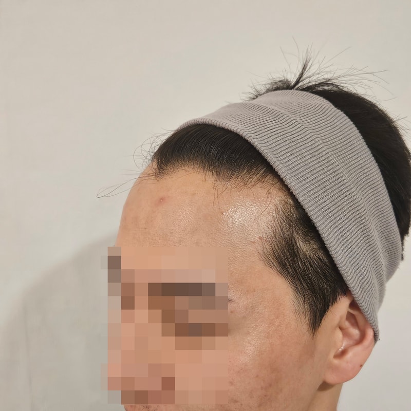 헤어라인교정 모발이식 17일 모원성형외과 정재홍원장님