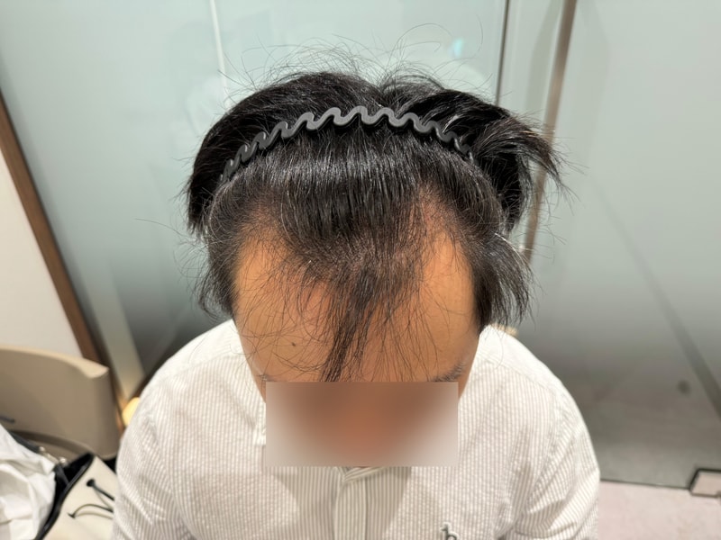 무삭발 비절개 모발이식 모원성형외과 M자탈모 5일차