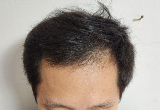 모원성형외과 정재홍원장님 / 비절개_투블럭 모발이식 5일차 후기 작성해봅니다