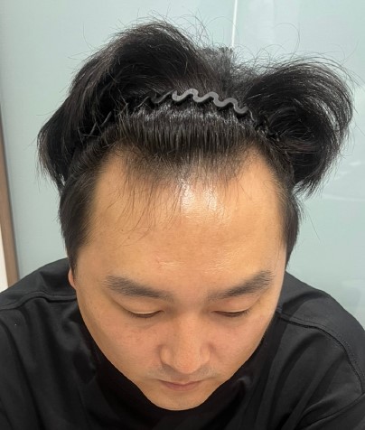 모원성형외과 부분삭발비절개 모발이식후기 공유합니다.