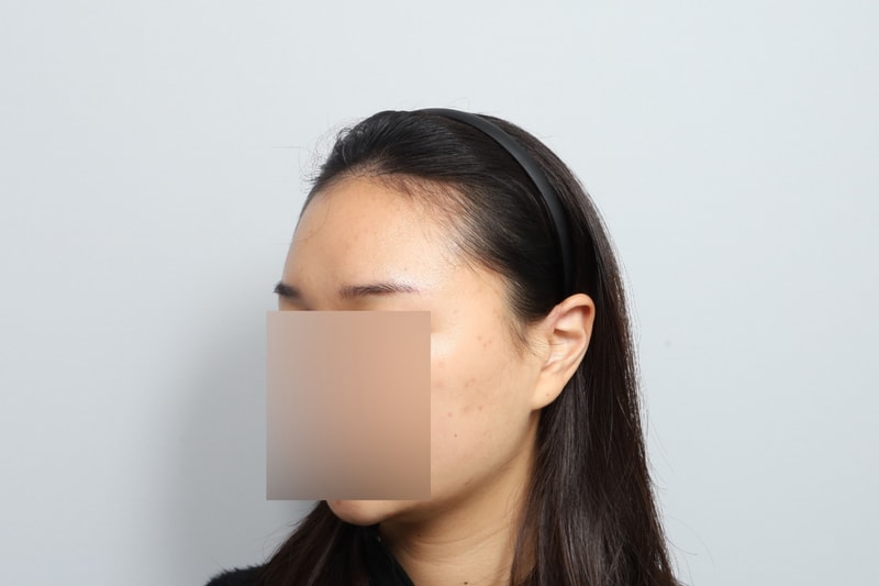 헤어라인 비절개 모발이식 1일차 모원성형외과