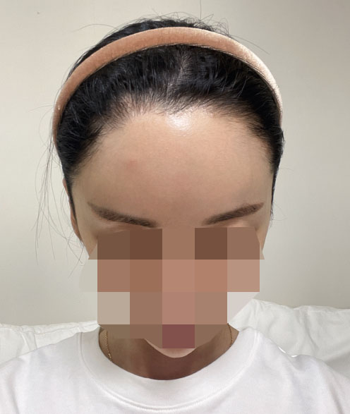 모원성형외과 재수술 헤어라인+밀도보강 1일차(박종옥원장님)