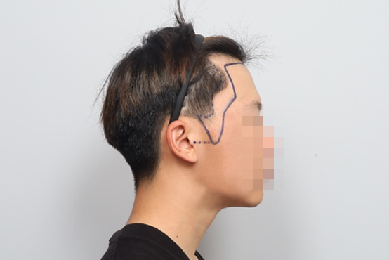 모원성형외과 윤곽대신 모발이식했습니다!