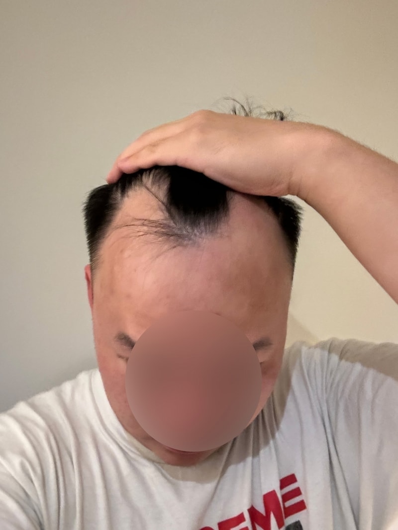 모원성형외과 M자이마 투블럭 비절개모발이식 7개월입니다