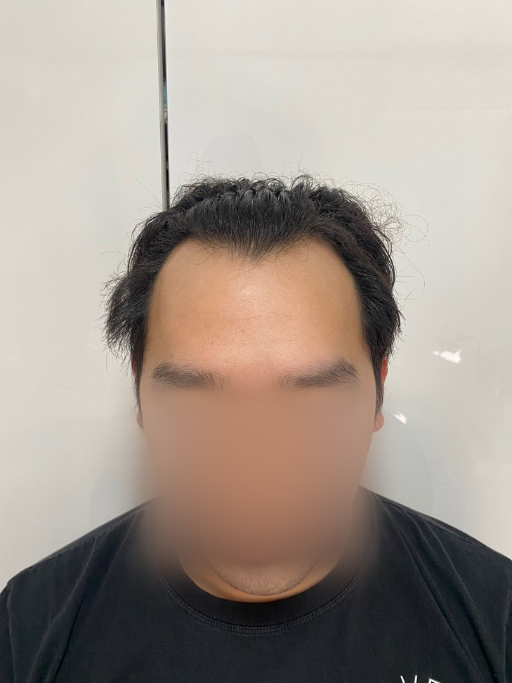 모원 성형외과 1822모낭 비절개 부분삭발 15일차 벌써부터 만족해요