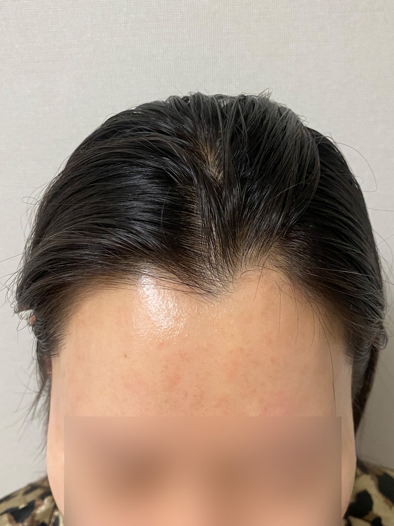 여자헤어라인 비절개모발이식 3개월째 모원성형외과
