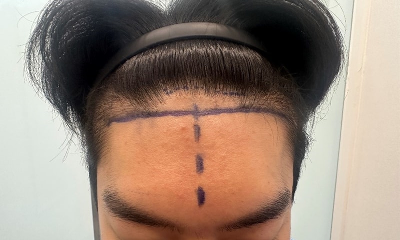 모원성형외과 모발이식후기(무삭발비절개) #수술당일