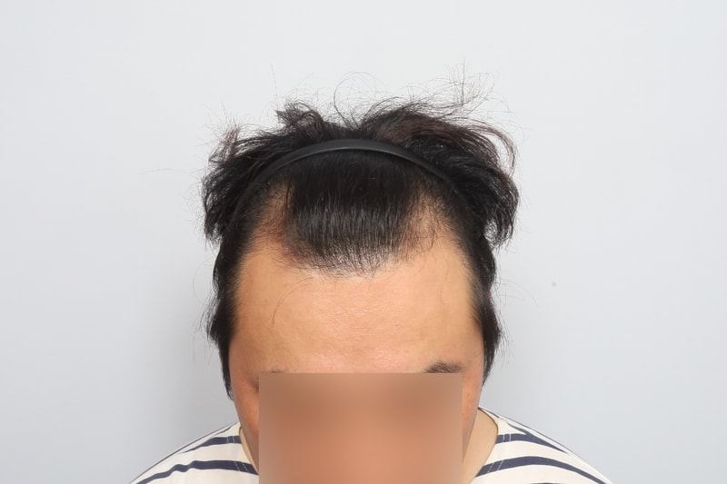 M자 탈모 모원성형외과 무삭발 비절개 모발이식 7개월 후기