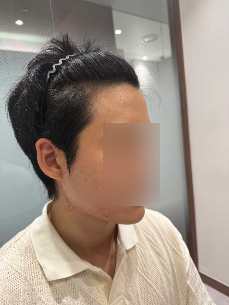 헤어라인교정 무삭발 비절개 모발이식 1일차 모원성형외과