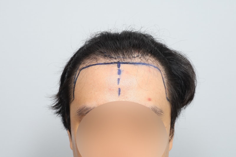 모원성형외과 M자이마 헤어라인 모발이식 1800모낭 무삭발 비절개 1일차