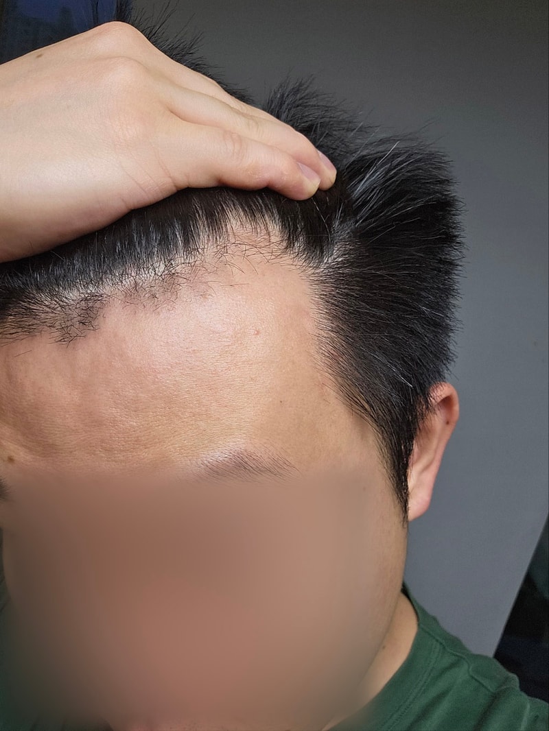 모원성형외과 M자 모발이식 4개월차 전후 차이 어떤가요~!?