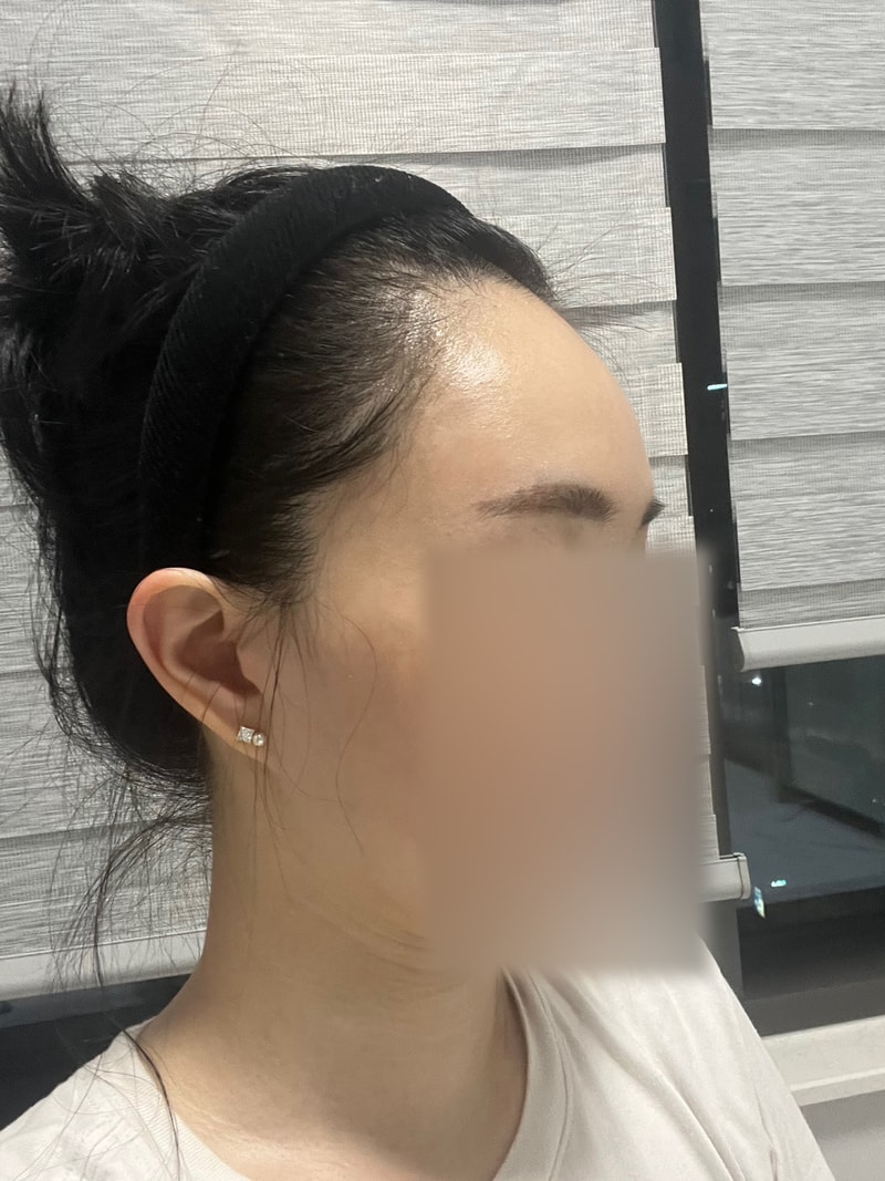 헤어라인 모발이식 3개월이예요 모원성형외과 박종옥원장님