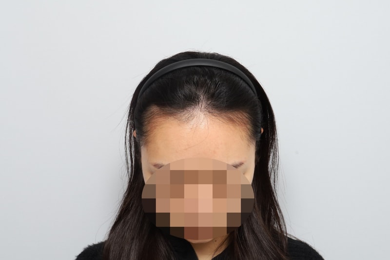모원성형외과 헤어라인 비절개 모발이식 7개월차
