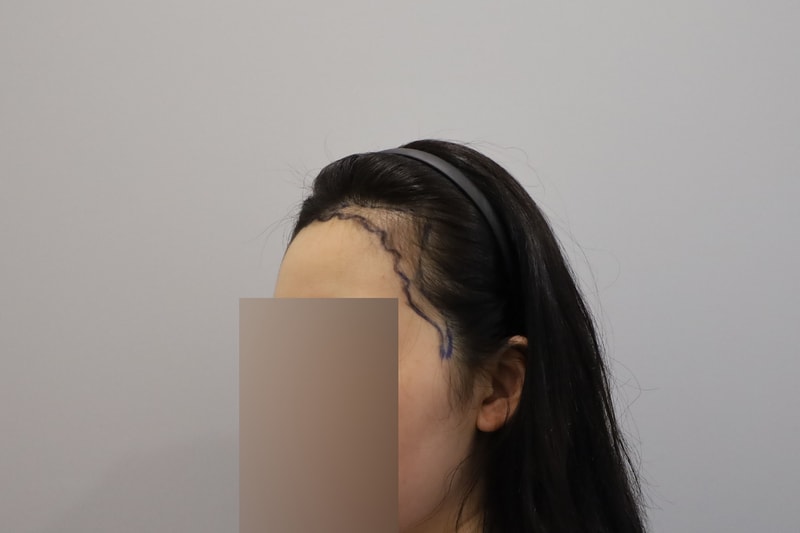 Women's Hairline Hair Transplantation in the 2nd Week of Mowon Plastic Surgery