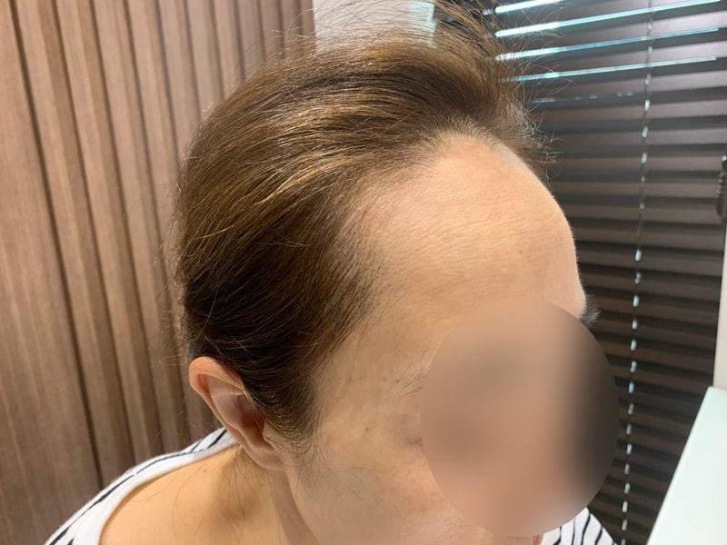 모원성형외과 부분삭발 헤어라인 모발이식 7개월<박종옥원장님>