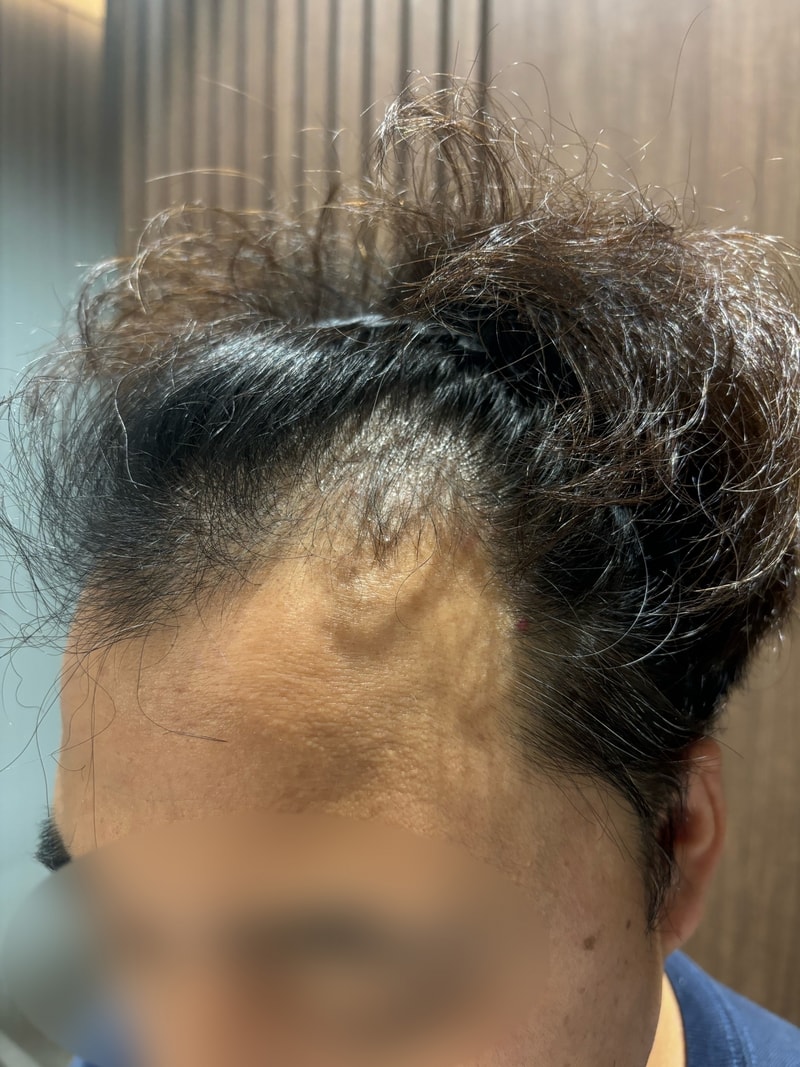모원성형외과 모발이식 12일차 경과 정재홍원장님