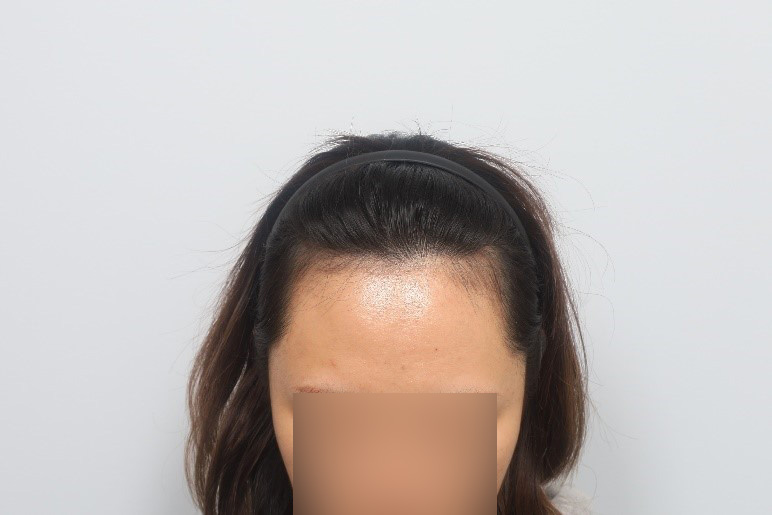 여자헤어라인 부분삭발 비절개모발이식 3개월 모원성형외과
